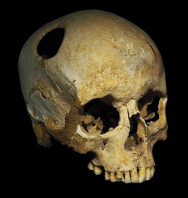施行顱骨穿孔術的痕跡，在出土的新石器時代女性頭骨上被發現，孔洞有癒合痕跡、邊緣平滑，但要在頭骨開孔的原因，則無從得知。（圖片來源：Wikimedia）