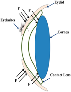 眼角膜周圍的應力集中現象